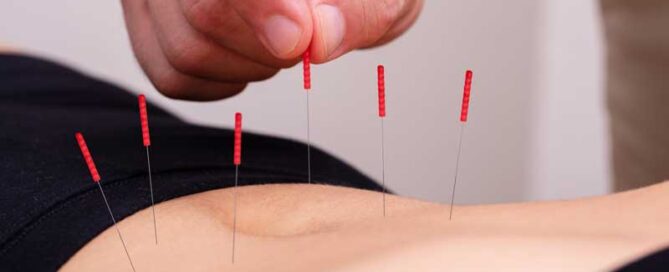 hand placing acupuncture needles on stomach